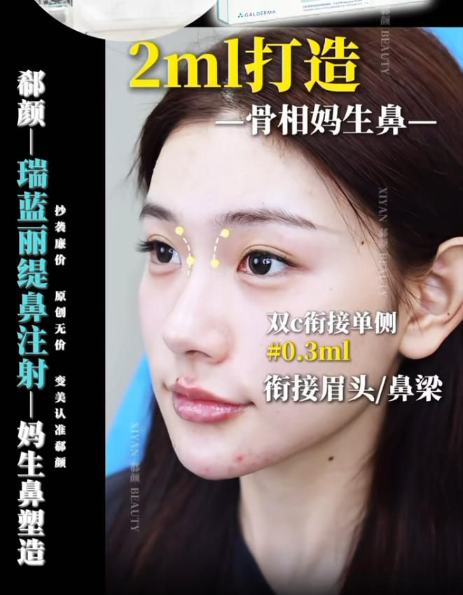 上海不用动刀的精致鼻_沈亚鑫精致鼻注射案例
